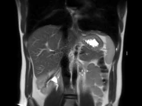 What does the spleen look like on MRI?