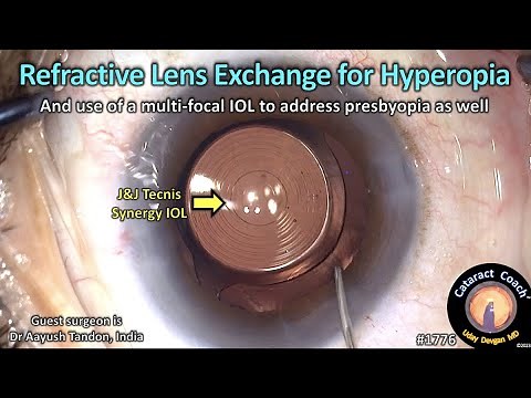 CataractCoach™1776: refractive lens exchange for hyperopia with Tecnis Synergy