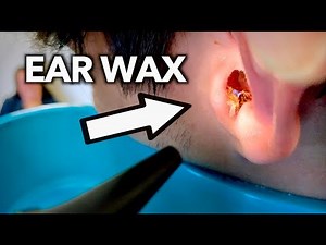 JUICY EAR WAX REMOVAL | Dr Paul