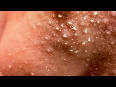 Satisfying Pimple Popping ASMR — Huge Zit & Blackhead Removal