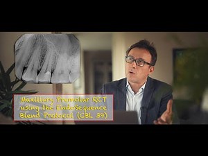 Premolar Root Canal using EndoSequence Blend Protocol CBL 37