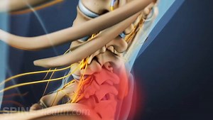 L5-S1 Posterior Lumbar Interbody Fusion Animation