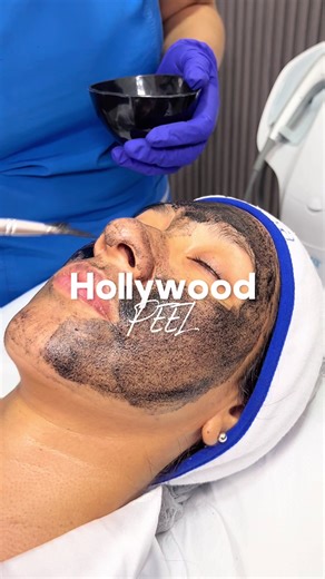 Hollywood PEEL✨👩‍⚕️ Tratamiento no invasivo que une el carbón activado con la precisión del láser Q-switch. En INNOVA cada sesión inicia con una evaluación personalizada 💙 Contáctanos al: 📲 953138979 #laser #dermatology #parati #rejuvenecimiento