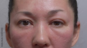 allergies, rosacea, rosacea, redness of the skin, red spots on the cheeks, a woman with sensitive skin, a close-up of the patient's face