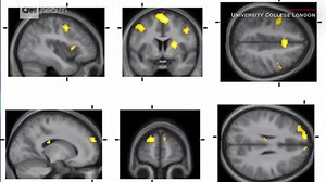 17K views · 345 reactions | There seems to be a whole lot of hate in the world these days. Here's what hate looks like, inside your brain. | Dr. Sanjay Gupta | Facebook