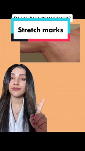 How to improve Stretch marks? 💗 #fyp #stretchmarks
