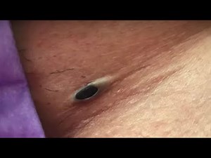 #013 Unbelievable Nose Blackheads Removal 😱 Huge Pimples Removal on Face & Acne Extraction