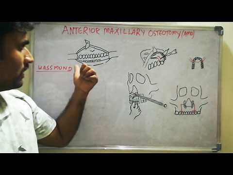 Anterior maxillary osteotomy - Wassmund method