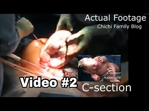 Video#2 C-section Real Footage OBGYN Cesarean Delivery Surgery Kaiserschnitt Birth experience