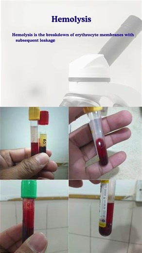 Hemolysis Basics in one minute #hemolysis #hemolyzed #mlt #laboratory
