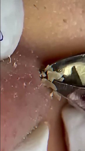 Skincare ｜ Blackheads Removal #tweezer #skincare #blackheads 4