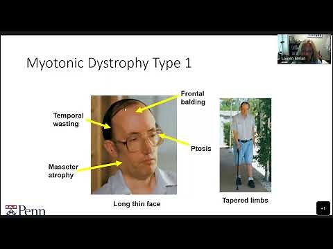 MDA Engage Webinar: Updates in Research and Treatments for Myotonic Dystrophy