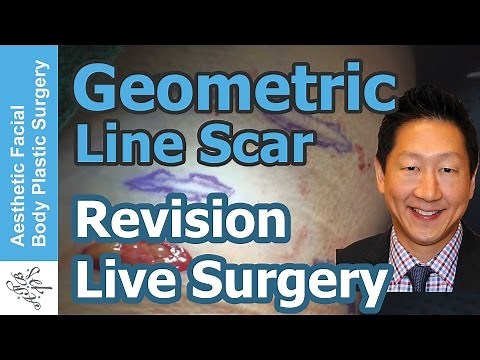 Live Surgical Scar Revision with a Geometric Line Closure. Get the Best Results with Scar Treatment