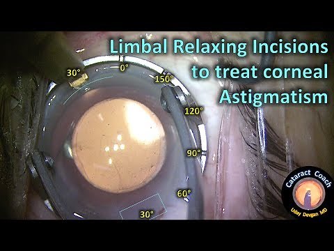Limbal Relaxing Incisions to treat corneal astigmatism during cataract surgery