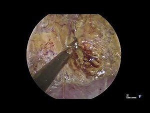 Function-Preserving Adrenalectomy for Aldosterone Tumor | Unedited Adrenal Surgery with Dr. Carling