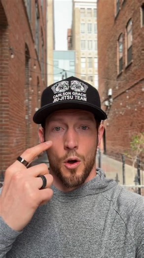 Understanding lower eyelid bags - what are they exactly? Are they lymphatic? Can you massage them away? Are there topical creams you can use to get rid of them? What about filler? It’s a very multi dimensional question. We need to think and understand 3-Dimensionally. Lower eyelid bags result from herniation, or anterior projection of the three fat pads in the lower eyelid that protect and surround the eyeball. There is a thin, soft tissue wall, called the septum that holds them back, and this i