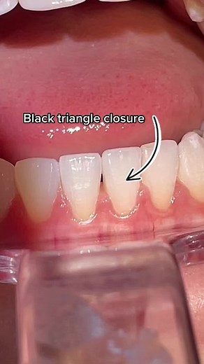 Closing Black Triangle with Composite Bonding