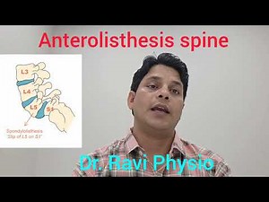Exercises for Anterolisthesis That Actually Work| Best Physiotherapist at CK Birla Hospital