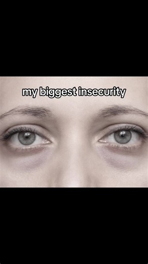 How to Reduce Eyebags and Puffy Eyes Effectively