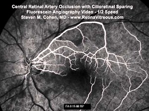 Central Retinal Artery Occlusion with Cilioretinal Artery Sparing - Fluorescein Angiogram Video
