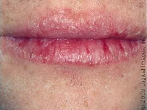 HUGE BUSTED LIP! | busted lip healing | How to Treat a cut lip