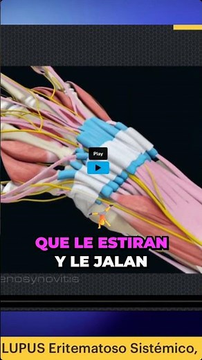Tenosinovitis de De Quervain: anatomía del pulgar explicada, síntomas claros y cuándo infiltrar