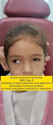 Duane retraction syndrome- DRS type 3