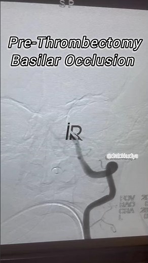 #basilararterystrokes Removing blood clot from a large artery in the brain #Mechanicalthrombectomy