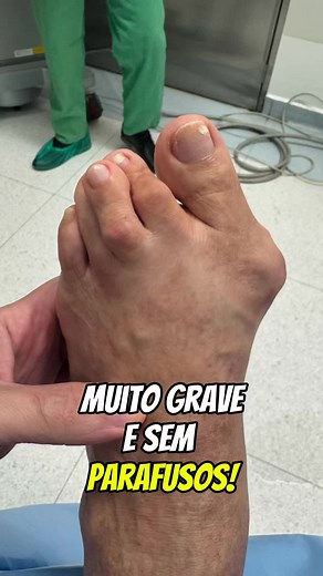 Como lidar com joanetes: dicas e cirurgia