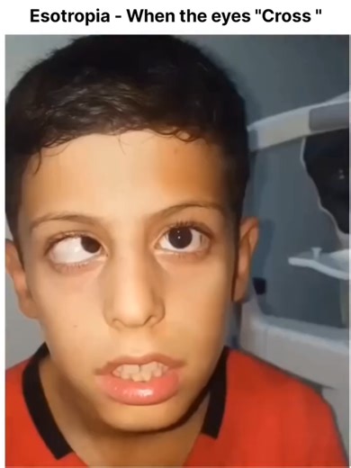 Understanding Esotropia: The Hidden Impact of Crossed Eyes