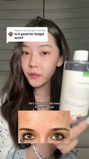 Best Toner for Closed Comedones and Fungal Acne