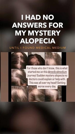 I Had No Answers For My Mystery Alopecia Until I Found Medical Medium
