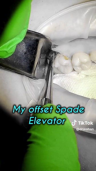 Step-by-Step Guide to Maxillary Third Molar Removal