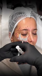 Medial Cheek Injections: Small Moves, Big Impact ✨💉 The central cheek plays a vital role in midface support and youthful contour. ✔ Strategic Volume – restoring projection without overfilling ✔ Depth Control – supraperiosteal placement for natural lift ✔ Smooth Transitions – blending seamlessly into the tear trough and lateral cheek Want to learn exact placement and technique? Message me “PROFILING” to join the lesson 📩 #facialprofiling #cheekfiller #injectortechnique #aesthetictraining #media