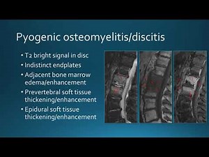 Extradural spinal infection