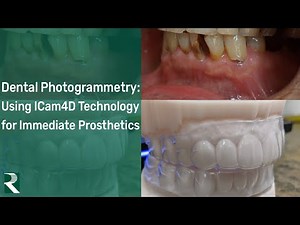 Full Arch Dental Photogrammetry: Using ICam4D Technology for Immediate Prosthetics