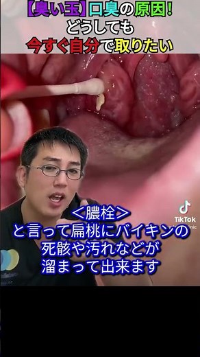 【臭い玉】口臭の原因！どうしても今すぐ自分で取りたい時の対処法
