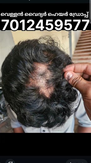 വയനാടും നാട്ടുവൈദ്യരും on Instagram: "മുടി സംബന്ധമായ എല്ലാ പ്രശ്‌നങ്ങൾക്കും ശാശ്വത പരിഹാരമായി വെള്ളൻ വൈദ്യർ Contact number : 7012459577 UAE : +971588981630"