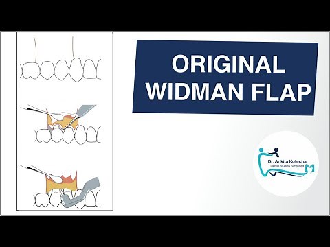 ORIGINAL WIDMAN FLAP/PERIODONTAL FLAP SURGERY TECHNIQUE/DR. ANKITA KOTECHA/DENTAL STUDIES SIMPLIFIED