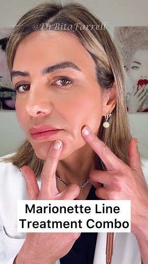 The cause of marionette lines is multifactorial. They develop from loss of structural support in front of the fold, including bone remodeling of the mandible, fat pad descent, and volume loss in the chin and jawline. At the same time, the repetitive downward pull of the DAO muscle gradually turns the corners of the mouth downward and deepens the crease. If you only inject directly into the line, you are treating the surface and not the cause. In this treatment, I restored support along the chin 