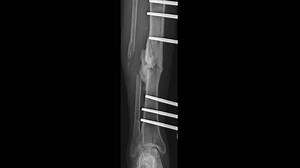 X-ray Assessment Tibia Fibula Fracture Fixation Stock Footage Video (100% Royalty-free) 3525509689 | Shutterstock