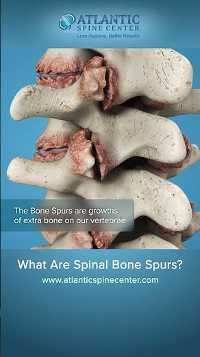 Back Pain Due to Spinal Bone Spurs?
