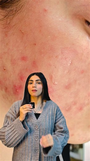 Activated charcoal and tea tree oil work together in a purifying soap bar to gently cleanse and mattify oily skin, leaving a refreshed, balanced feel. Infused with nourishing coconut, olive, and castor oils, this 100% natural bar purifies without stripping moisture, leaving skin balanced, smooth, and refreshed. #acnemarks #instatrending #fyp #viral #goodsoaps #fyp #handmade #acnemarks | Good Soaps