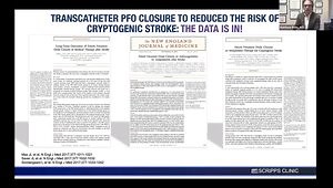 Deploy, Lock, Release: GORE® CARDIOFORM Septal Occluder Device Basics and Closing Simple PFO Cases