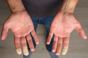 Doigts blancs : quelles sont les causes du syndrome de Raynaud ?