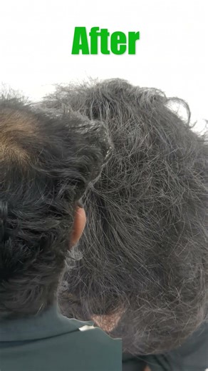 Real GFC Hair Growth Result Before & After 😱🚨