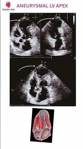 ANEURYSMAL LV APEX – ECHOCARDIOGRAPHY CASE #EchoDxHub #Echocardiography #CardiacSonography