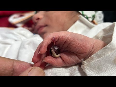 Polydactyl Baby – Extra Finger Miracle | Full Checkup & Detailed Examination