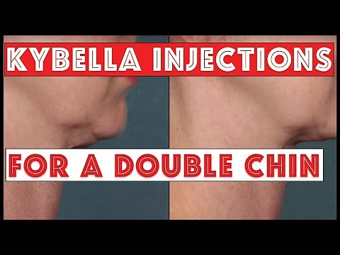 Kybella Injections to treat a Double Chin: No Surgery needed
