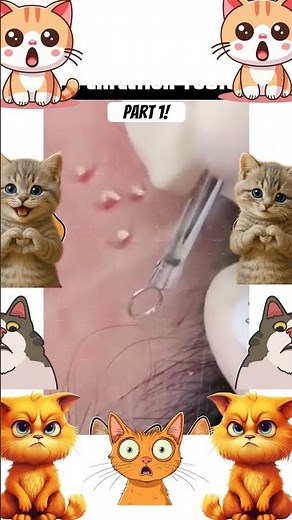 JUICY Double Cyst 😷💦 Huge pop!!